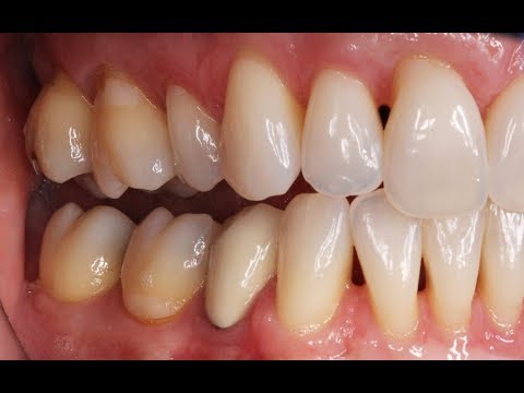 Видео: Что это за черные треугольники между зубами?
