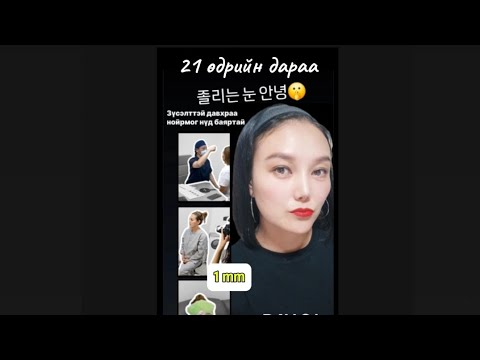 Видео: Зүсэлттэй давхраа 21 хоногийн дараа #1 / 졸리는 눈 안녕 일미리 성형외과 fb: 1 mm MONGOLIA 1MM PLASTIC SURGERY