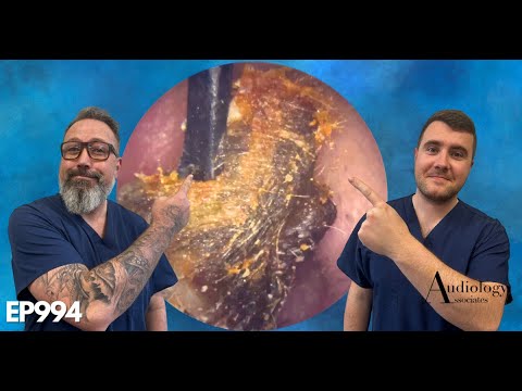 Видео: МЫ ИСПОЛЬЗОВАЛИ РУЧНОЙ ИНСТРУМЕНТ ДЛЯ УДАЛЕНИЯ УШНОЙ СЕРЫ - EP994