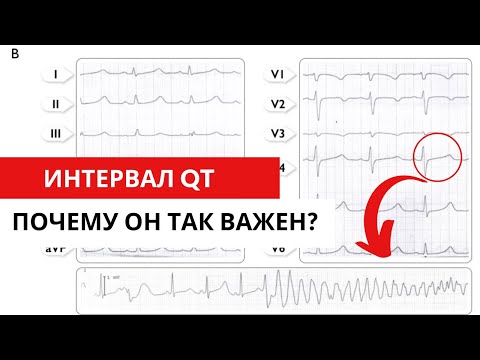 Видео: Интервал QT. Как рассчитать? Синдром удлиненного и укороченного интервала QT.