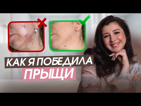 Видео: Мой честный опыт борьбы с акне!