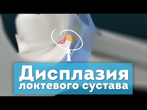 Видео: Дисплазия локтевого сустава. Патогенез. Elbow Dysplasia 3D