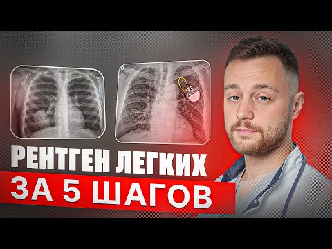 Видео: 5 простых шагов для чтения рентгена легких