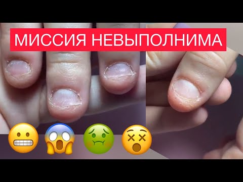Видео: САМЫЕ ОБКУСАННЫЕ 😱 КОРОТКИЕ НОГТИ ГРЫЗУНА 🤔 КАК СДЕЛАТЬ  Наращивание миндаль💅