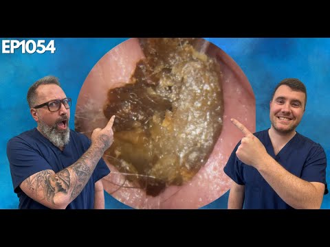Видео: Удаление массивных ушных серных пробок — EP1054