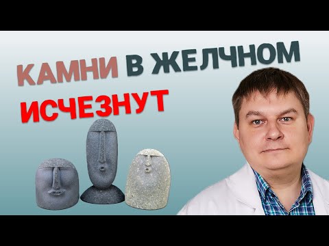 Видео: Удалять желчный или камни исчезнут от таблеток? Развенчиваю мифы о камнях в желчном!