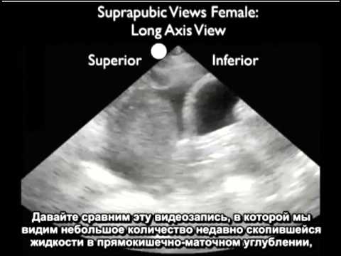 Видео: Порядок выполнения: исследование FAST — визуализация надлобковой области