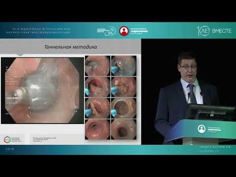 Видео: Дивертикул Ценкера