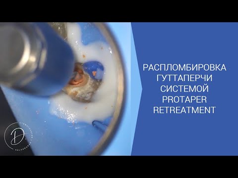 Видео: Распломбировка гуттаперчи системой protaper retreatment и soco