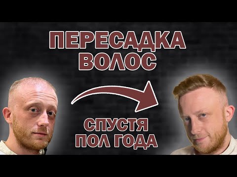 Видео: Результат пересадки волос | Нужна ещё одна? | Процесс восстановления
