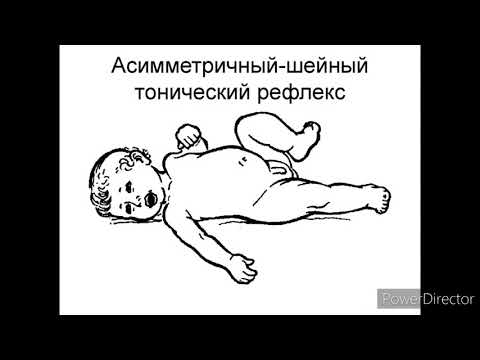 Видео: Ассиметричный шейный тонический рефлекс. ДЦП