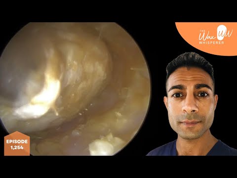 Видео: 1,254 - Удаление и отшелушивание омертвевших кожных пробок у земноводных