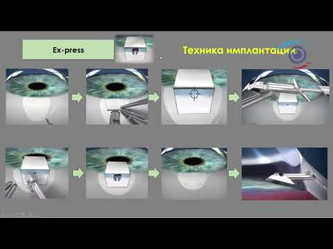 Видео: Дренажная хирургия глаукомы: клапан Ahmed и мини-шунт Ex-press: за и против