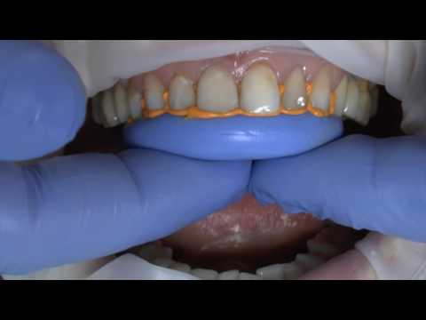 Видео: Изготовление силиконовых ключей