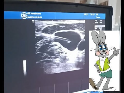 Видео: Катетеризация яремной вены под УЗИ контролем (косым доступом)