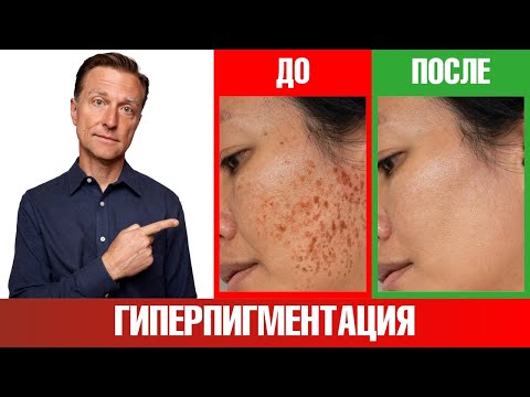 Видео: Как избавиться от пигментации любого происхождения?✅