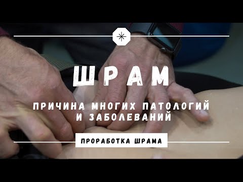 Видео: Шрам - Кинезиология. Проработка Шрама.