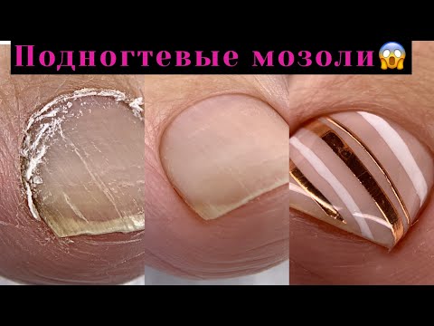 Видео: Как убрать подногтевые мозоли💅Секреты чистого педикюра😍Педикюр за 1,5 часа