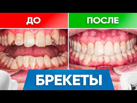 Видео: Брекеты До и После – реальные примеры работ со взрослыми пациентами