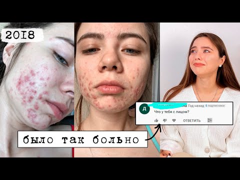 Видео: Моя история борьбы с акне 💔 ОТ НАЧАЛА И ДО КОНЦА