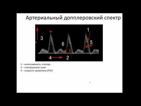 Видео: Допплеровская спектральная кривая.Что есть норма?