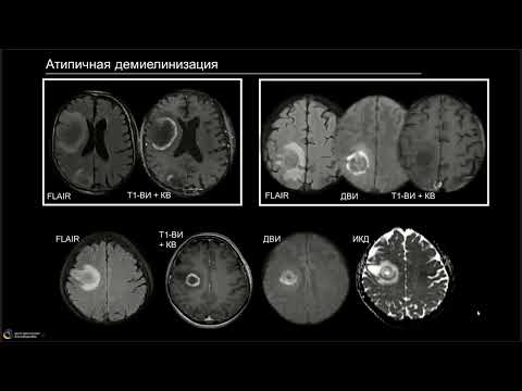 Видео: Вебинар: «Демиелинизирующие процессы: о чем помнить помимо рассеянного склероза?»