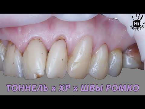 Видео: ТОННЕЛЬ х XP-доступ (не VISTA) х швы РОМКО: закрытие множественных рецессий десны на верхней челюсти