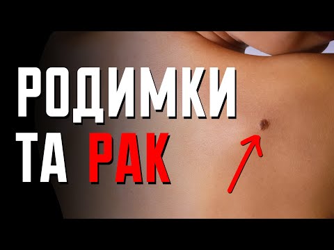 Видео: Чи може родимка перетворитися на рак? | Клятий раціоналіст