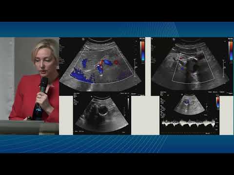 Видео: Абдоминальная ишемия: возможности ультразвуковой диагностики. Шульгина Л.Э.