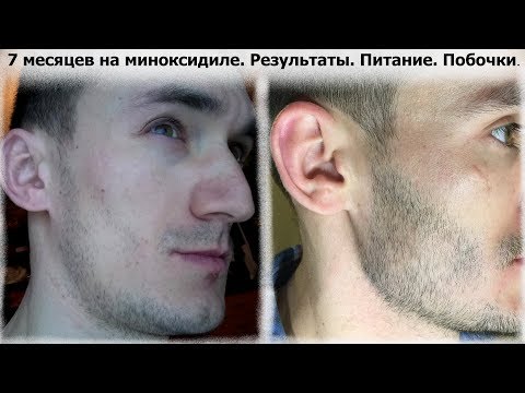 Видео: Миноксидил 7 месяцев. Результаты.  Питание.  Побочки.