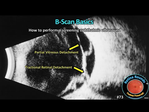 Видео: RetinaRounds™ 73: Основы B-сканирования