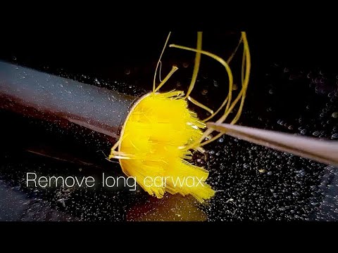 Видео: ASMR Длинная удаление ушной серы, которое вы никогда не видели больше нигде😉No talking