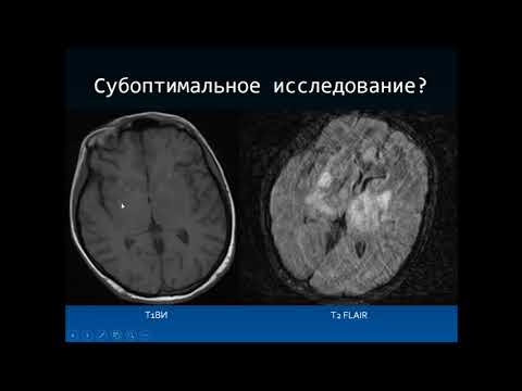 Видео: Дроздов А.А. «Дифференциальная диагностика ВИЧ индуцированных энцефалитов»