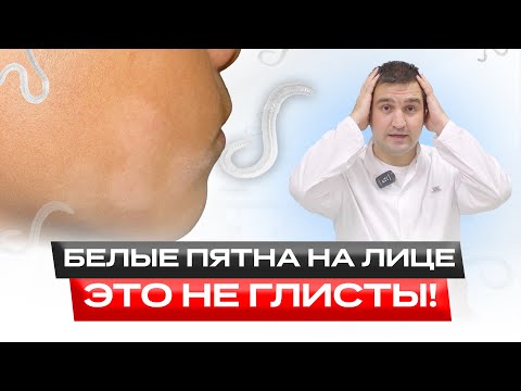 Видео: Настоящая причина белых пятен | Это не глисты | Лечение чесноком | Это поможет!