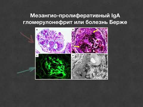 Видео: IgA нефропатия, мезангио-пролиферативный гломерулонефрит или болезнь Берже