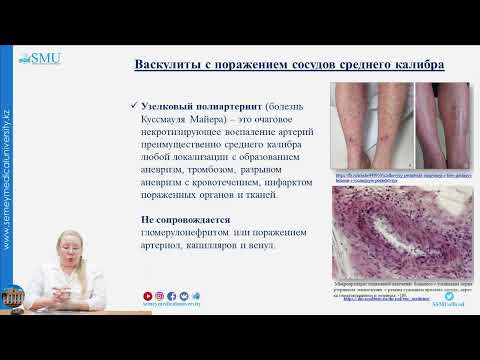 Видео: Системные васкулиты