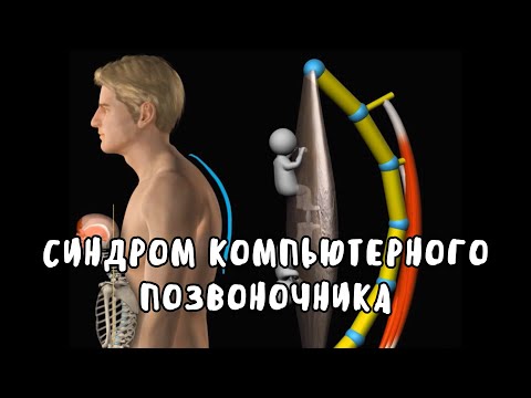Видео: Синдром компьютерного позвоночника
