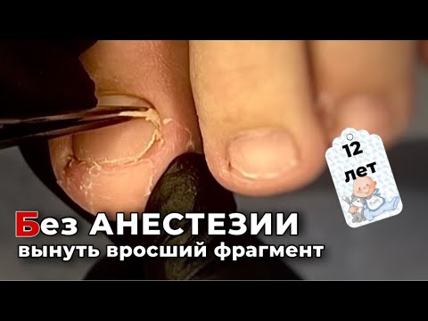 Видео: Хотели к хирургу, но ребенок решил к подологу. Вросший ноготь в 12 лет