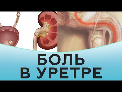 Видео: Боль в уретре у мужчин лечение