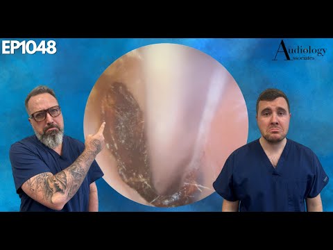 Видео: Удаление ушной серы: катастрофа, в которую вы не поверите - EP1048