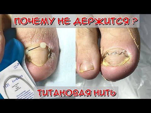Видео: Почему не держится титановая нить? / Установка коррекционной системы