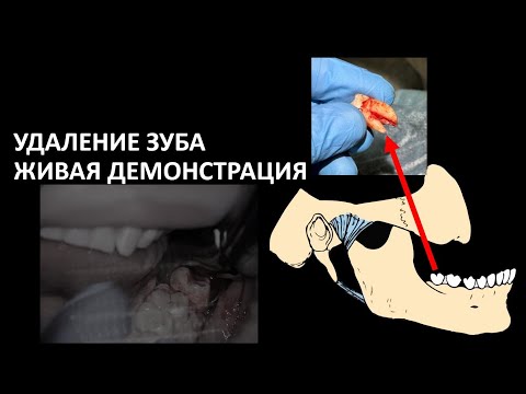 Видео: УДАЛЕНИЕ ЗУБА ЖИВАЯ ДЕМОНСТРАЦИЯ И СОВЕТЫ НОВИЧКАМ