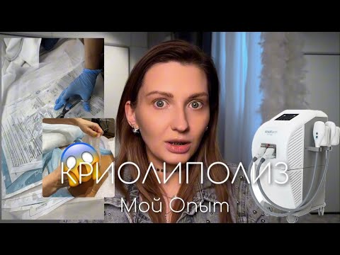 Видео: КРИОЛИПОЛИЗ Мой Опыт | Как я жир замораживала и Где результат