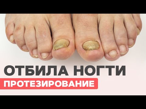 Видео: Отбила ногти на ногах| Хирург не помог| Протезирование
