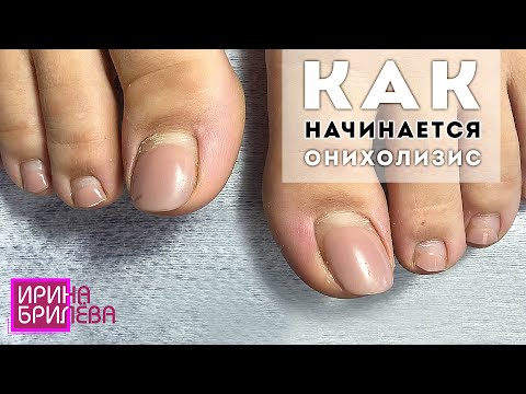 Видео: ПЕДИКЮР и длинные ногти 🌸 Как начинается ОНИХОЛИЗИС