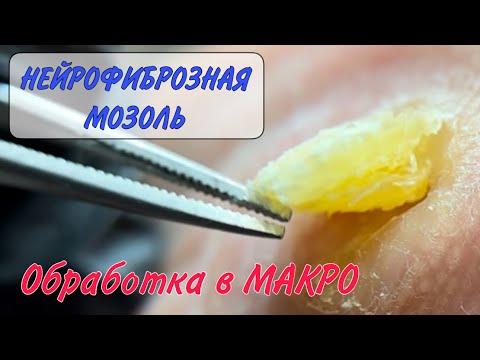 Видео: ‼️мозоль на ноге/ нейрофиброзная мозоль/ как убрать мозоль на ноге