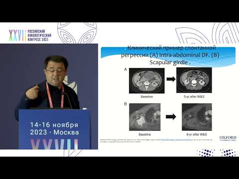 Видео: Тактика лечения операбельного агрессивного фиброматоза (десмоид)