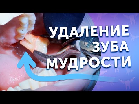 Видео: Процесс удаления зуба мудрости