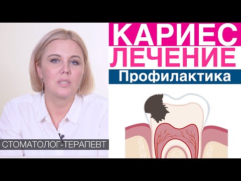 Видео: Кариес - основные методы лечения без сверления, со сверлением. Профилактика кариеса. Метод Icon