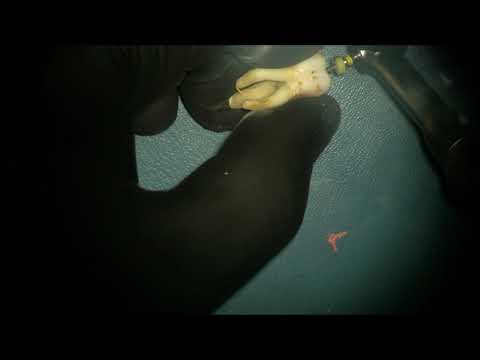 Видео: Простая и быстрая распломбировка  канала от гуттаперчи